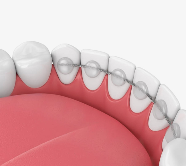 Dental illustration showing upper teeth and pink gums in a smile arc arrangement.