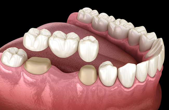 3D dental model showing teeth alignment and gum structure on pink tissue base.