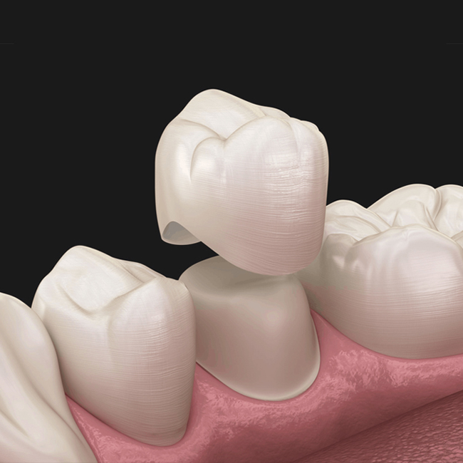 Dental crowns illustration showing tooth restoration on pink gum model against black background.