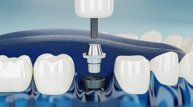 Dental implant model showing tooth replacement procedure with artificial tooth and implant post between natural teeth.