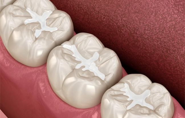 Three dental crowns displayed on pink model gum showing restorative dentistry work.