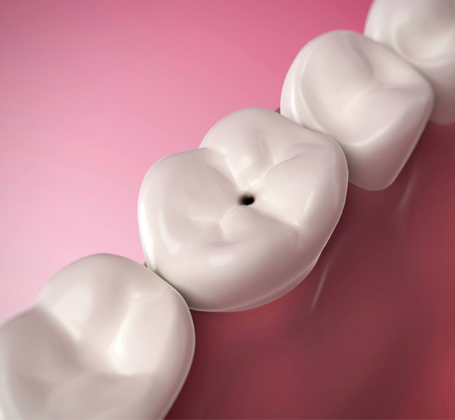 White dental models showing tooth structures against pink background for dentistry education.