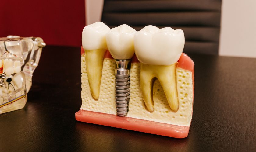 Dental Implants Arden - Arden Family Dentistry